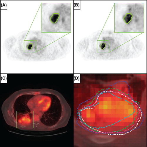 Figure 2. A and B. Representative images of repeated imaging of a patient from the test-retest cohort, with the 50% SUVmax tumor delineation shown outlined in green, for, respectively, the first and second baseline PET scan. C. Representative image of a patient from the inter-observer cohort, where the lesion area is outlined with the green square (fused CT for illustrative purposes). D. Enlargement of the lesion area with in different colors the five independent tumor delineations by multiple observers.