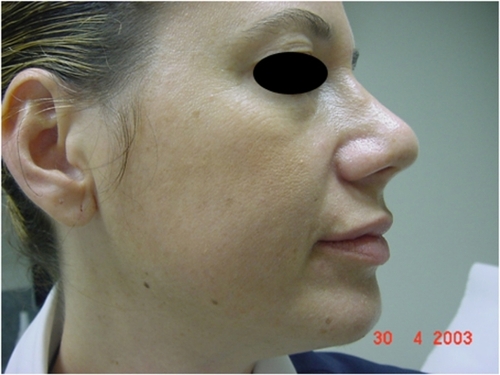 Figure 4B Hyaluronic acid filler for facial sculpturing (midface) two weeks after injection.