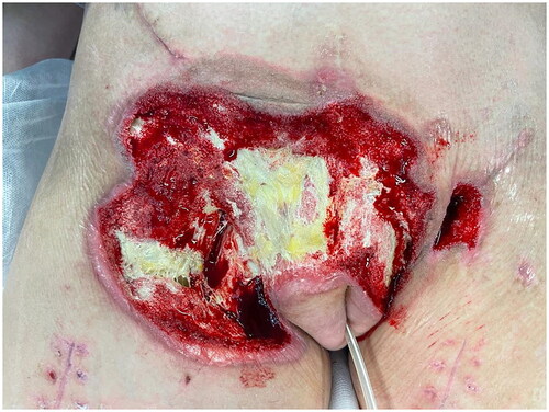 Figure 2. The pubic area after excision necrosis and 20 days of NPWT.