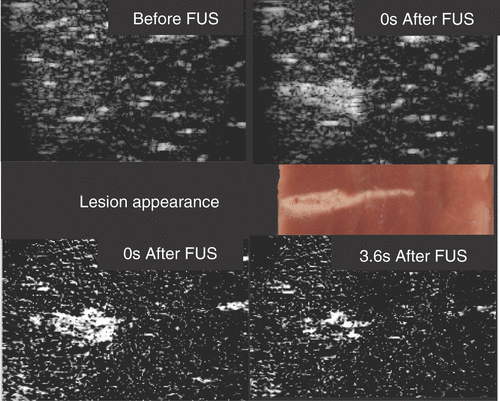 Figure 1. Ultrasound backscatter image monitoring of a 3100 W cm−2 (free field spatial peak intensity) exposure of excised bovine liver imaged with a Z.One scanner (Zonare Medical Systems Inc., USA) using an 8-MHz linear probe. The FUS beam was incident from the left. Top images are B-scan images obtained with a frame rate of 14 Hz. Middle is a photograph of the lesion. Bottom are subtraction images: left is the result of subtracting the top left B scan from the top right; right is a similar result using a B scan image obtained 3.6 s later. The hyperechogenicity is due to bubbles, probably from boiling, and the reduction with time is due to cooling. Courtesy of Jim McLauglan, Institute of Cancer Research.