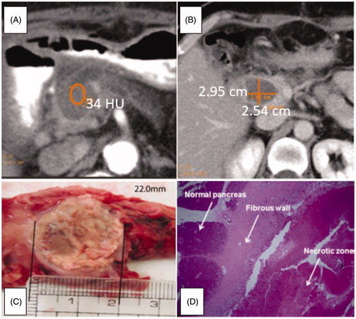 Figure 3. Radiofrequency Ablation: A) Measurement of Hounsfield Unit value of the RFA induced lesion in pancreatic adenocarcinoma and B) of the necrotic area. Reprinted from [Citation43] Copyright 2018, with the permission of Pioneer Bioscience Publishing Company. C) Gross pathology of the porcine RF-ablated pancreas. D) Hystological image of the thermal outcome: coagulated necrosis, fibrous tissue and normal pancreatic parenchyma. (H&E, orig. mag. x40). Reprinted from [Citation39] Copyright 2018, with the permission of Elsevier.