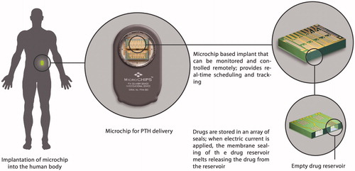 Figure 8. An implantable microchip for releasing parathyroid hormone fragment (1–34) [hPTH(1–34)] (Farra et al., Citation2012).