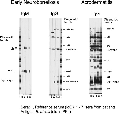 Figure 2. Whole cell immunoblot from patients with early neuroborreliosis(stage II) and acrodermatitis (stage III). Note, the antigen used is B. afzelii strain PKo and the sera are from European patients. Figure 2 is modified from Figure 5 of reference Citation71.