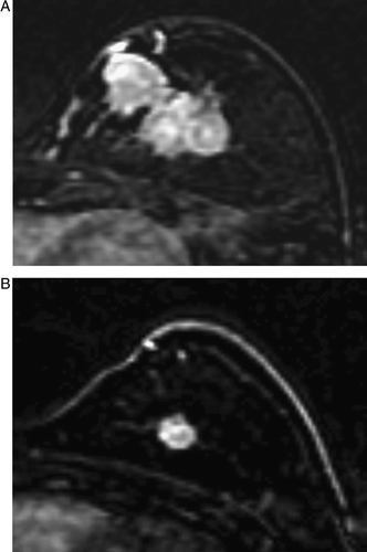 Figure 3.  MRI before (A) and after (B) chemotherapy in a case showing a shrinkage pattern of the tumor response. The mass, measuring as 5.0×3.2 cm before chemotherapy (A), decreased to 1.5×1.5 cm and showed a shrinkage pattern of MRI after chemotherapy (B). The size of the residual tumor according to the pathologic assessment agreed with that determined by MRI, 1.4 cm maximum.