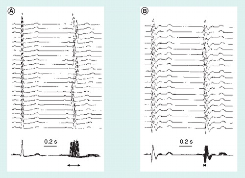 Figure 2. Recording the heartbeat by thoracic electrodes.The top traces show the variation in latency of the second QRS complex with respect to the first and the bottom traces show the same recordings superimposed to better appreciate the ‘jitter’ of the second QRS complex (horizontal arrows) and the differences between (A) a healthy subject and (B) a patient with autonomic dysfunction in the context of Chagas disease.