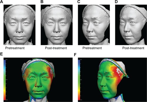 Figure 3 A 36-year-old Japanese woman (A and C) pretreatment and (B and D) 60 days post-treatment, and (E and F) three-dimensional color schematic representation. The varying degrees of tightening achieved are shown in colors yellow to red. Green areas indicate areas that remained unchanged. Two treatments with a one-month interval between treatments were performed on the cheeks with four passes at 42 J/cm2 (100 shots). Significant improvements were noted in the gray image and three-dimensional color schematic representation. Volume reduction was 3.140 mL.