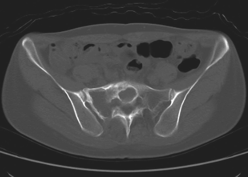 Figure 2. A 32-year-old female with fibrous dysplasia in the sacrum. More than half of the sacral body was occupied by the tumor, which invaded the sacral canal to a slight degree. Computed tomography showed good bone formation of the curetted wall 1 year after the operation.