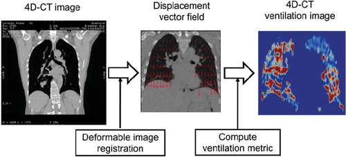 Figure 2. Schematic diagram for creating a 4D-CT ventilation image through deformable image registration and quantitative analysis of the resultant displacement vector field for computing the ventilation metric.