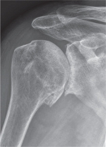 Figure 2. A radiograph showing the classical findings of subchondral sclerosis, joint space narrowing, marginal osteophytes and subchondral bone cysts in a patient with glenohumeral osteoarthritis.