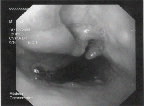 Figure 1. Endoscopy showing a deep ulcer of the oesophagus at 21 cm of the dental arcade.
