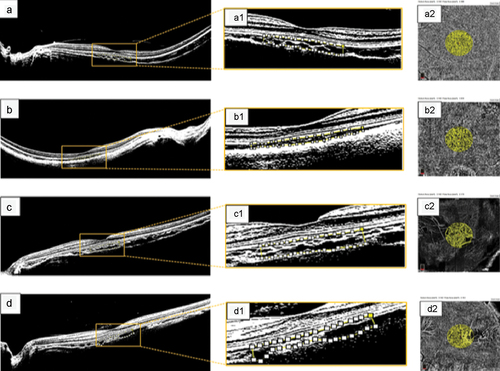 Figure 1. Protocol depicting the method used for quantifying the CVI in healthy myopic eyes. (a) binarized image designed to depict the intraretinal structure and choroidal layers in greater detail in a healthy, moderately highly myopic eye with an axial length of 27.8 mm. (a1) magnified image within the yellow square showing binarized processing of the subfoveal choroidal stroma and luminal vascular visualization of the subfoveal choroidal vessels to obtain a choroidal vascularity index (CVI) of 62.8% in a healthy, moderately myopic eye. The selected subfoveal area of choroidal flow is clearly delineated by the white dotted line. (a2) quantified choriocapillaris flow area (CFA) of 2.308 mm2 in the protocol-selected area of 3.142 mm2 in this healthy myopic eye. (b) binarized processing of choroidal flow in a healthy highly myopic eye with an axial length of 30.8 mm and enhanced choroidal vessel visualization, yielding a CVI of 59.4%. (b1) the magnified image within the white‒yellow dotted line clearly delineates a CVI of 1.972 mm2. (c) binarized image corresponding to a healthy, highly myopic eye in the control group; the CVI was 63.4% inside the selected choroidal flow area. (c1) magnified image depicting the selected area for the CVI measurements. The white and yellow dotted lines depict the binarized choroidal flow area selected to calculate the CVI. (c2) the CFA was 2.173 mm2 for the selected choriocapillaris. (d) binarized image in a healthy highly myopic eye with an axial length of 29.6 mm and a CVI of 58.2%. (d1) magnified image of the selected central subfoveal area clearly depicting the CVI area defined by the white dotted line. (d2) the CFA area was 1.737 mm2.