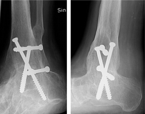 Figure 3. Ankle no.20.Radiographs (A and B) obtained 2 years after open surgery. The ankle is fused.