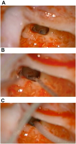 Figure 3. Cochlear implant electrode placement surgery. Surgical image of the right ear, posterior tympanotomy, stapedial tendon and pyramidal process with adequate visualization of the round window. (A) Previous insertion of the cochlear implant electrode. (B) Initiating cochlear implant electrode insertion. (C) Complete cochlear implant electrode insertion.