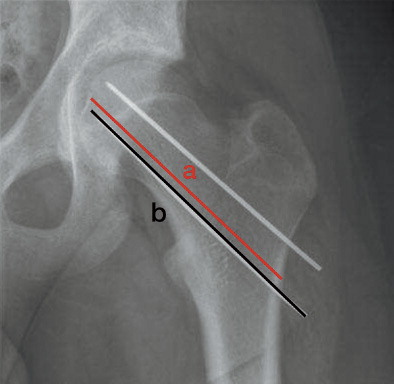 Figure 4. Method of calculating the ratio between lengths of the femoral neck and pin. a: length of femoral neck; b: length of Steinmann pin. Ratio: a/b.