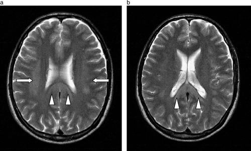 Figure 2a & b.  Axial diffusion- (Figure 1a & b) and T2- (Figure 2a & b) weighted images showing restricted diffusion and T2 signal hyperintensity involving the corona radiata (arrows) and splenium of the corpus callosum (arrowheads) in a symmetrical manner at initial presentation.