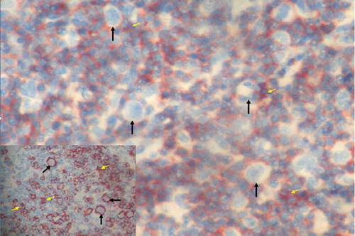 Figure 5. Reed–Sternberg cells (white arrows) and CD3-positive reactive small lymphocytes (yellow arrows) in lymph node sections (ABP, CD3, ×200). Inset: CD20-positive Reed–Sternberg cells (arrows) and CD20-positive reactive small B lymphocytes (yellow arrows) in lymph node sections (ABP, CD20, ×200). ABP, avidin biotin peroxidase method.