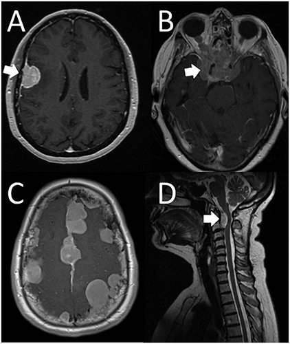 Figure 1. Meningioma clinical variety. A. Patient presented with a seizure and left hemiparesis, and had a WHO grade II meningioma excised uneventfully. B. Patient presented with visual deterioration, and had 2 surgeries, and radiotherapy over a 20 year period for a WHO grade I meningioma. Vision deteriorated further and the meningioma continued to grow. C. Patient with NF2 and multiple meningiomas presented de novo with headache at 52 yrs old. D. Patient presented with progressive weakness (Figure 1D courtesy of Dr S Mills, The Walton Centre, Liverpool).