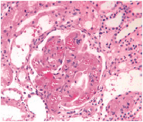 Figure 4. Photomicrographs showing ischemic shrinkage of capillary tufts with dilated and congested capillary lumina, loss of mesangial anchorage and presence of few fibrin thrombi in glomerular capillaries. (Masson's Trichrome × 250).