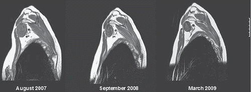 Figure 2. Fibromatosis of brachial plexus PLD 50 mg/m2 × 6 – August 2007 to January 2008, late partial remission, markedly improved mobility of hand and shoulder, with reduced analgesic requirement. Images: August 2007, September 2008, March 2009.