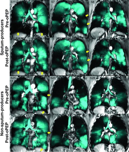 Figure 2.  3He MRI ventilation in representative sputum and non-sputum-producers. Pre- and post-oPEP ventilation (in cyan) registered to 1H anatomical MRI (in grey-scale) for sputum- and non-sputum-producers. Yellow arrows identify regional differences in 3He ventilation post-oPEP. Sputum-producers: S11, 56 year-old female, Δ FEV1 = −11%pred, Δ FVC = −13%pred, Δ 6MWD = −78m, Δ SGRQ = 20, Δ VDP = 6%. S7, 72 year-old female, Δ FEV1 = −6% pred, Δ FVC = −24% pred, Δ 6MWD = −24m, Δ SGRQ = 19, Δ VDP = 4%. S8, 79 year-old female, Δ FEV1 = 2%pred, Δ FVC = 3%pred, Δ 6MWD = −63m, Δ SGRQ = 2, Δ VDP = −3%. Non-sputum-producers: S25, 72 year-old female, Δ FEV1 = −5%pred, Δ FVC = 0%pred, Δ 6MWD = −18m, Δ SGRQ = −3, Δ VDP = 3%. S23, 77 year-old female, Δ FEV1 = −2%pred, Δ FVC = −2%pred, Δ 6MWD = 12m, Δ SGRQ = 2, Δ VDP = 1%. S28, 51 year-old male, Δ FEV1 = −1%pred, Δ FVC = −1%pred, Δ 6MWD = −6m, Δ SGRQ = −11, Δ VDP = −1%.