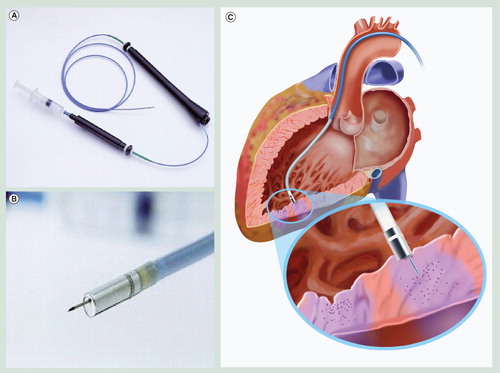 Figure 2. Delivery of stem cells to the left ventricle.(A) The MyoStar™ injection catheter allows precise delivery of stem cells based on the electromechanical map. (B) A magnified view of the distal tip. (C) Left ventricle illustrating direct stem cell delivery by the MyoStar™ injection catheter.Images courtesy of Biologics Delivery Systems Group Inc.