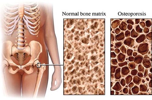 Figure 2. The decalcified osteoporotic bone.