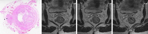 Figure 6.  A tumour nodule is seen apparently extending laterally from the right side of the primary tumour. There is no histological evidence that this nodule is associated with any vascular structure on this slide. Serial ascending axial MRI slices through the same tumour suggest that the nodule lies within a tubular structure running parallel to the bowel wall, and the upper-most image shows signal void indicating that this is likely to be a vein.