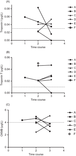 Figure 1. Time course for cardiac markers (troponin I, troponin T, and CKMB) for subjects with elevated troponin concentrations. 1, admission; 2, peak creatinine; 3, discharge. A, B, C, D, E, and F reflect the same patients as in Table 3. Dashed line = 0.03 μg/L (99th percentile). One value was omitted for visual clarity; it was a value of 0.24 μg/L for patient F.