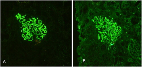 Figure 2. Detection of viral antigens and particles in renal tissues. Immunohistochemical staining of frozen renal tissue sections. (A) HBsAg and (B) HBcAg antigens are located in the glomeruli as indicated by brown staining in the glomeruli.
