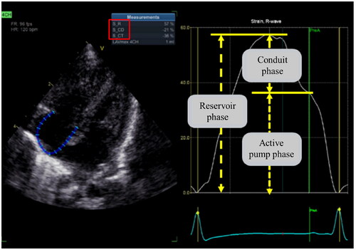 Figure 8. Right atrial strain (RA LS). The endocardial boundary of the right atrial was automatically delineated using two-dimensional speckle tracking echocardiography on the apical 4-chamber view, with a specific focus on the RA. RA LS consists of three phases: the reservoir phase, the conduit phase, and the active pump phase.