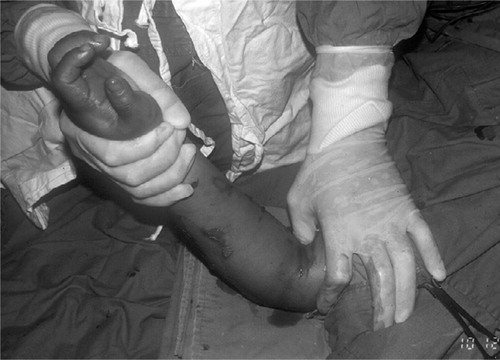 Figure 2. Reduction of the fracture through an anteromedial mini-incision. Thumb pressure is applied over the spike of the proximal fragment for control of rotation of the fragment and simultaneous traction is applied to the foream using the other hand.