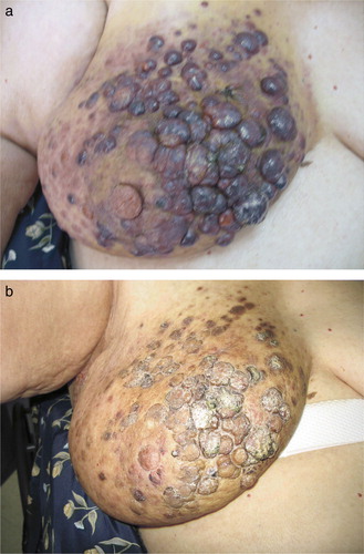 Figure 1.  (a) Angiosarcoma before treatment. (b) Angiosarcoma after 4 months of treatment with Paclitaxel.