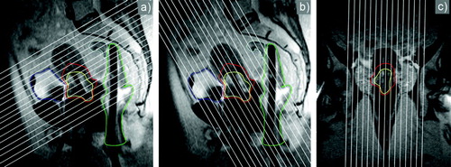 Figure 1.  The “Brachytherapy Eye View” illustrating a systematic relation between applicator geometry and image orientation. White lines indicate the selection of the appropriate image orientation parallel and orthogonal to the axis of the intrauterine tandem, as well as to the sagittal (a, b) and coronal (c) midplane of the ring: (a) para-transverse, (b) para-coronal and (c) para-sagittal sequences. Contours of GTV, HR CTV and OAR are given.