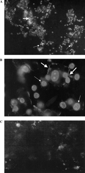 Figure 3The effect of 14-deoxy-11,12-didehydroandrographolide (EC50 values of 1.52 µg/ml, 72 h), on T-47D cell line as stained with Annexin-V-FLUOS™ kit (Roche, Germany). (A and B). The effect of 1% (v/v) DMSO, control vehicle on T-47D cell line. (C) Positive annexin V (thick arrows) and propidium iodide (thin arrows) stained cells were noted. Original magnification × 100 (A) × 400 (B, C).