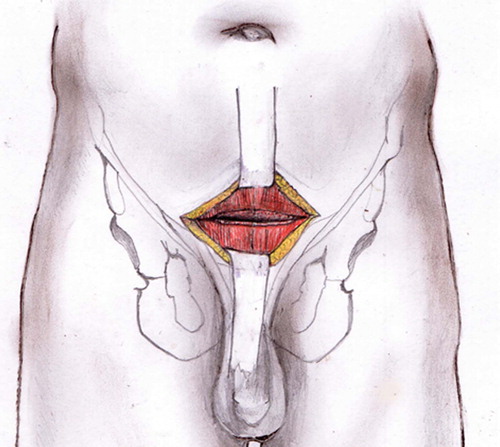 Figure 1. Pfannenstiel incision and transverse dissection of the rectus abdominis muscle.