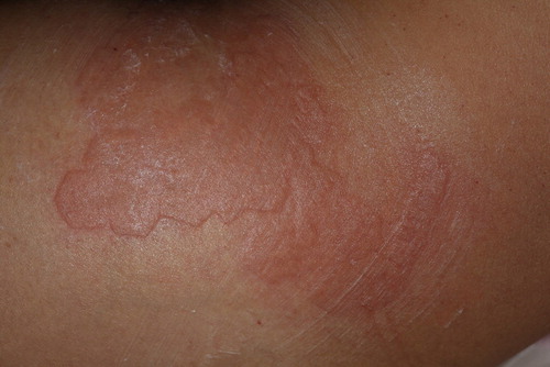 Figure 1. Skin appearance immediately after the procedure. Erythema and edema are conspicuous.