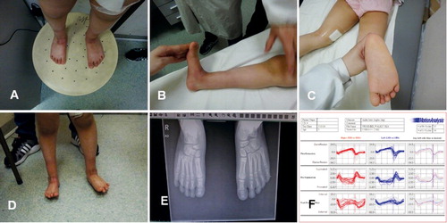 Figure 4. The same patient after repeated Ponseti treatment: ICFSG =4. (A–C) Morphology evaluation =1, (D) Muscle function =0, (E) Radiologic evaluation =3, (F) Gait analysis: dynamic function =0.
