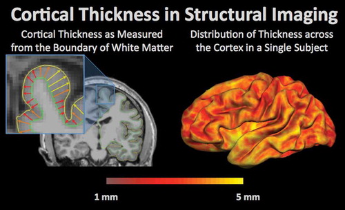 Figure 2. Cortical thickness in structural imaging is a measurement of the distance from the grey-white matter boundary (green outline) to the edge of the cortex, or pial surface (yellow outline). Cortical thickness can change with normal aging as well as pathology. An example of a single subject is shown on the right with yellow regions demonstrating the areas with the highest cortical thickness and thinner regions of the cortex in red.