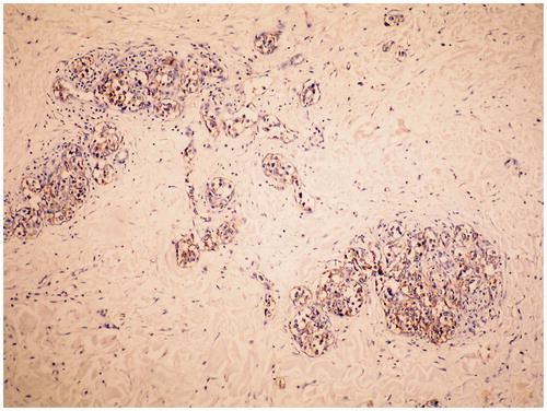 Figure 3. Intravascular large B-cell lymphoma. The tumor cells are highlighted by staining for CD 20 (Immunoperoxidase stain, original magnification × 10 objective).