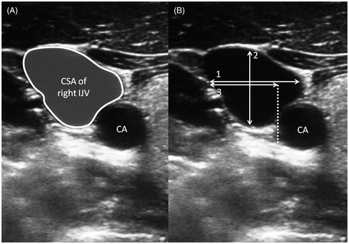 Figure 2. Ultrasound images of the right IJV and relationship with CA. (A) Cross-sectional area of right IJV. (B) (1) Transverse diameter of IJV, (2) A-P diameter of IJV and (3) safety margin. CA, carotid artery; A-P, anteroposterior; IJV, internal jugular vein.
