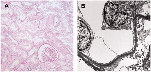 Figure 1. The first allograft biopsy on day 54 after transplantation showed no evidence of cellular or humoral rejection on light microscopy (A), however, revealed foot process effacement of podocytes on electron microscopy (B) which was compatible with focal segmental glomerulosclerosis.