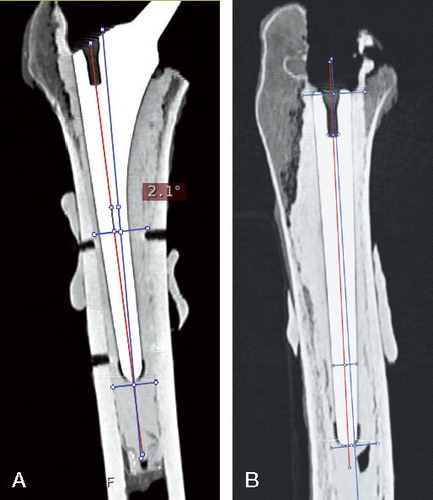 Figure 4. The axes of implant and femoral canal on both coronal (A) and lateral projections (B). Red line: axis of the femoral stem; blue line: femoral axis.