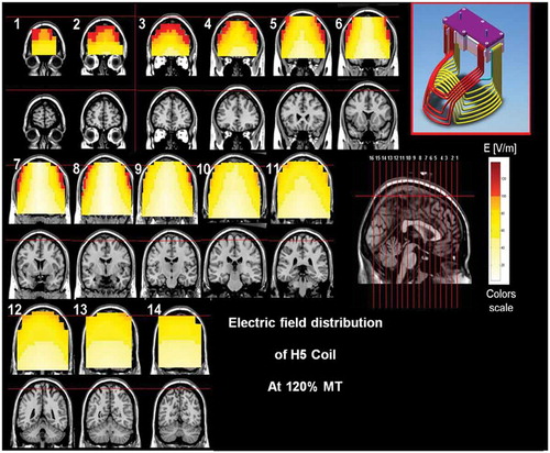 Figure 6. Colored field maps for the H5-coil indicating the absolute magnitude electrical field in each pixel at 120% of hand motor threshold, for 14 coronal slices 1 cm apart. Red pixels indicate regions with field intensity above the threshold for neuronal activation. Full color available online.