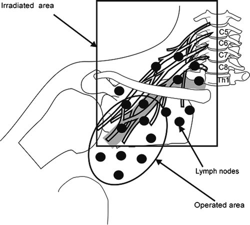 Figure 1.  Schematic representation of the brachial plexus in relation to the borders of irradiated field and operated area.