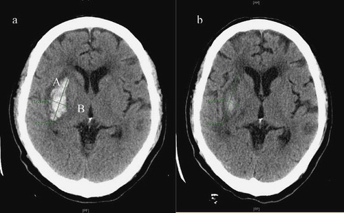 Figure 1.  Methods for volume of hematoma and interval change of CT: (a) admission, (b) two weeks later. On the CT slice with the largest area of ICH, the largest diameter (A) of the hematoma was measured by use of the centimeter scale on the CT film. The diameter of the hemorrhage perpendicular to the largest diameter represented the second diameter (B). The height of the hematoma was calculated by multiplying the number of slices involved by the slice thickness, providing the third diameter. The three diameters were multiplied and then divided by 2 (AxBxC/2) to obtain the volume of ICH (this formula was validated by Kwak et al.).