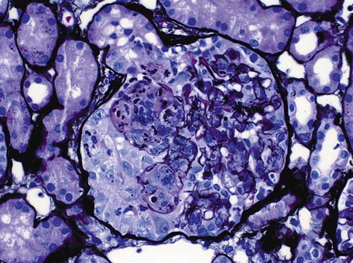 FIGURE 1. Glomerulus with a cellular crescent in the Bowman's space as well as endocapillary proliferation with fibrinoid necrosis (Jones methenamine silver; original magnification ×400).