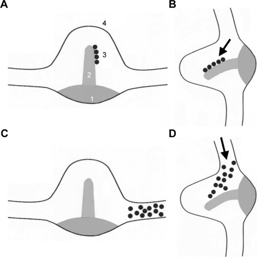 Figure 1 Theories of posterior semicircular canal stimulation in BPPV.