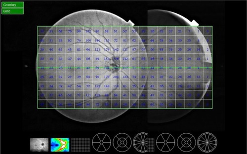 Figure 1 Retinal images were acquired using the swept-source Deep Range Imaging-OCT (DRI-OCT-1, Topcon, Tokyo, Japan).