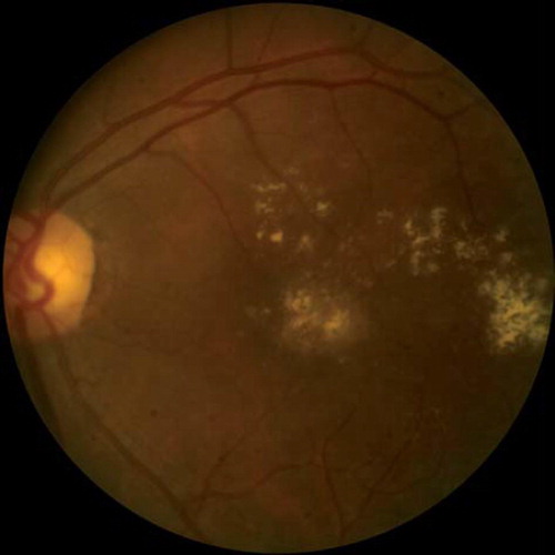 Figure 2. Fundus photograph demonstrating accumulation of lipid exudates in a patient with clinically significant diabetic macular edema.