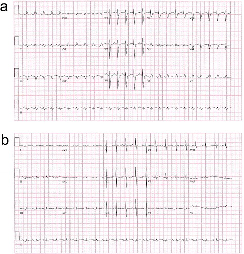 Figure 2. After treatment with bicarbonate infusion. An EKG obtained soon after initiation of bicarbonate (a), and after several hours on a maintenance drip (b), which shows interval narrowing of the QRS complex.